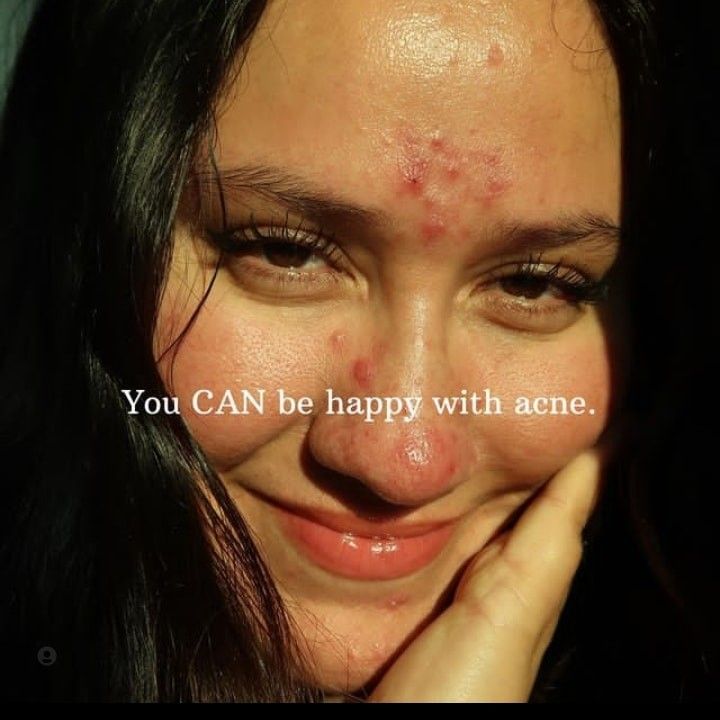 Acné chronique : comment garder espoir au quotidien