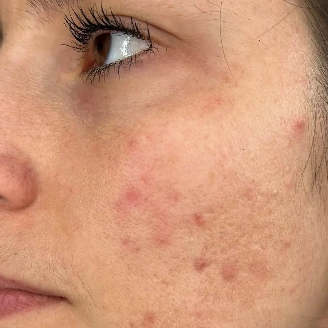 5 erreurs fréquentes qui aggravent l’acné sans qu’on s’en rende compte Bazik cosmetics