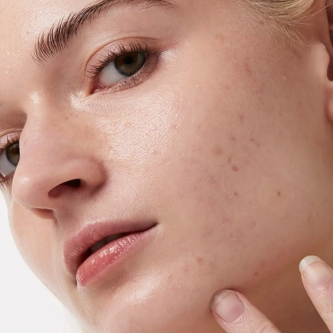 Pourquoi mon acné revient-elle tous les mois ? Comprendre l’acné hormonale adulte Bazik cosmetics