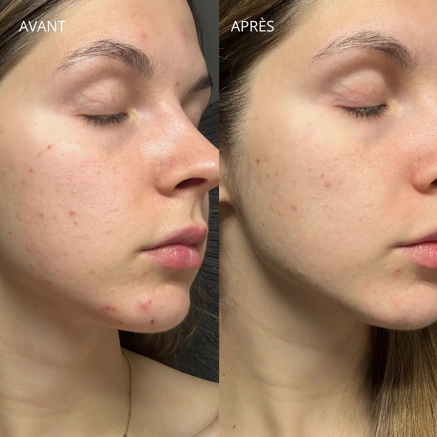 BB crème couvrance légère peau acnéique Bazik Cosmetics
