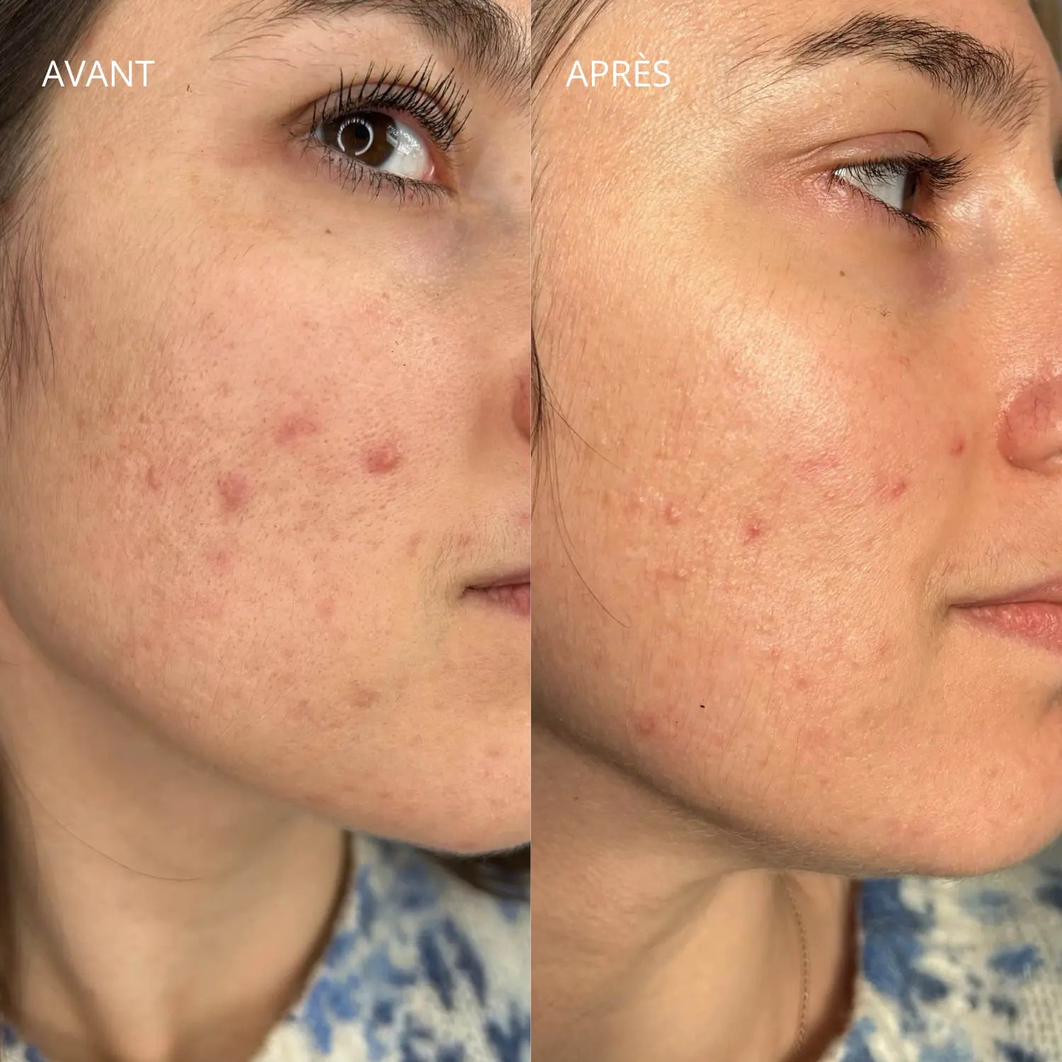 BB crème couvrance légère peau acnéique Bazik Cosmetics